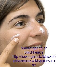 how to get rid of blackheads 1 (c) akshikinkar how to get rid of hives