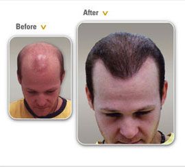 hair photo:herbal hair loss 